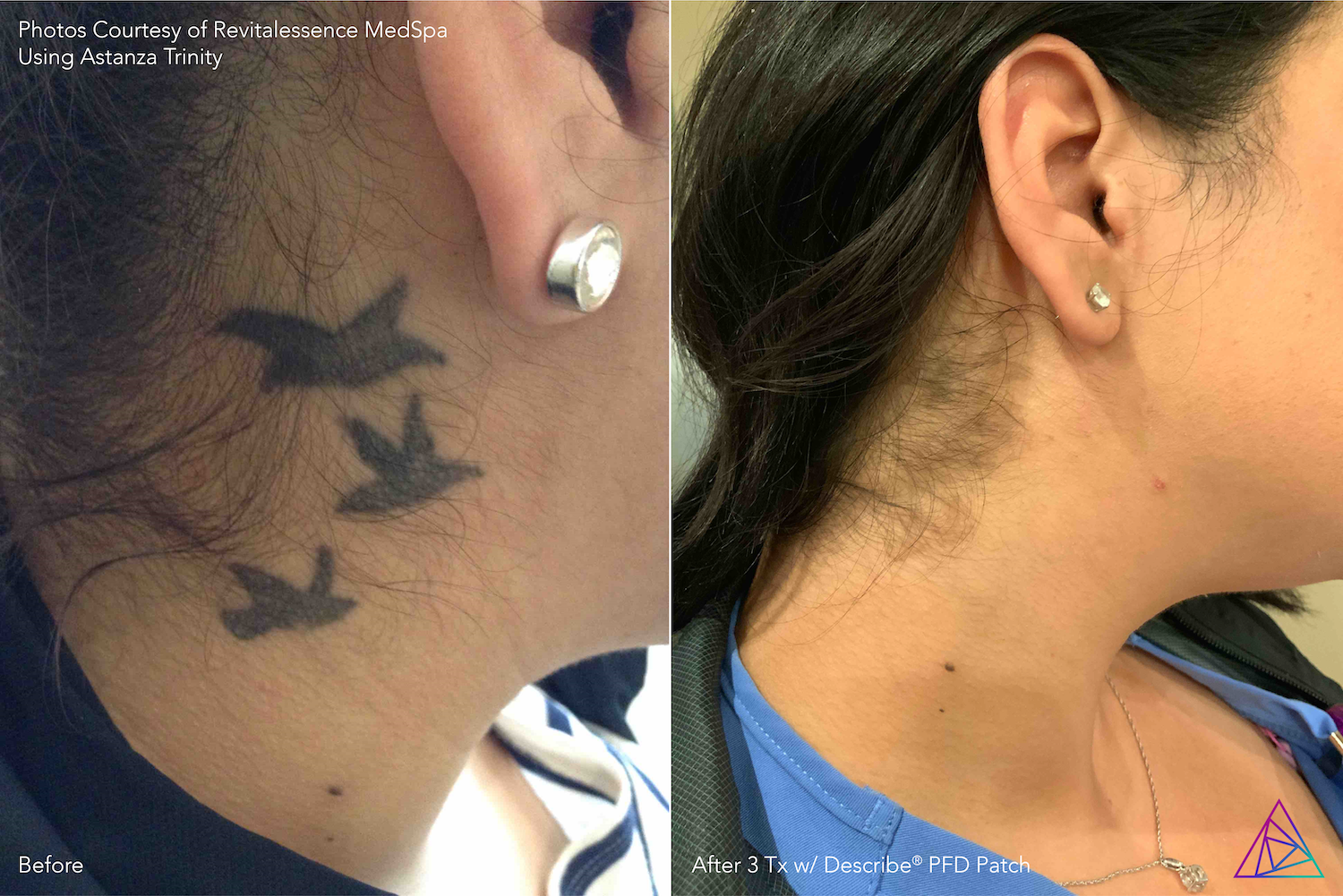Before and after tattoo removal